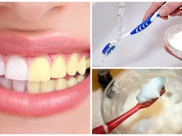 formas-blanquear-dientes