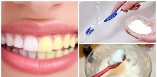 formas-blanquear-dientes