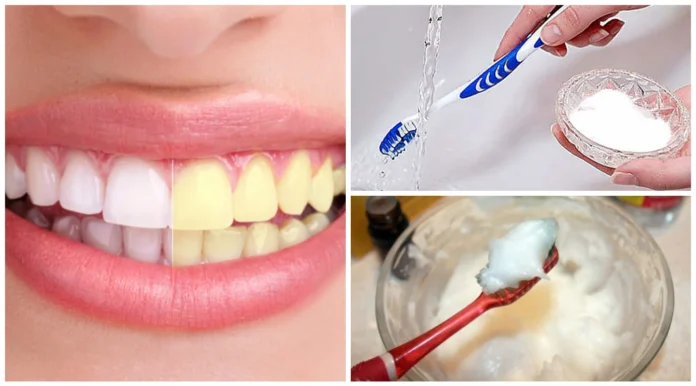 formas-blanquear-dientes