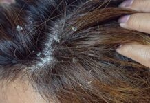 ¡Dile adios a la caspa! Remedios naturales para combatirla caspa