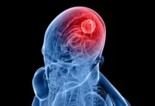 Científicos rusos logran combatir tumores cerebrales agresivos con nuevos fármacos rusos-combatir-tumores