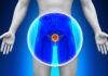 Expertos aconsejan a hombres priorizar su salud prostática pruebas-existen-cancer-de-próstata-1