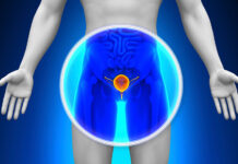 Expertos aconsejan a hombres priorizar su salud prostática pruebas-existen-cancer-de-próstata-1