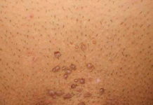 Zona Clímax | VPH en hombres: Síntomas, cura y tratamiento